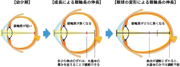 眼軸長