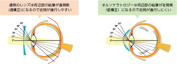 オルソケラトロジー